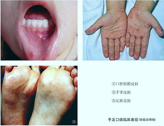 手口足病