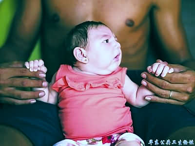 zika小头症